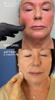 Endolift®  face lifting by Dr. Milena
