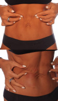 Endolift® Abdomen lifting: B&A