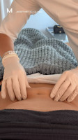Endolift® Abdomen lifting by Dr.Milena: B&A